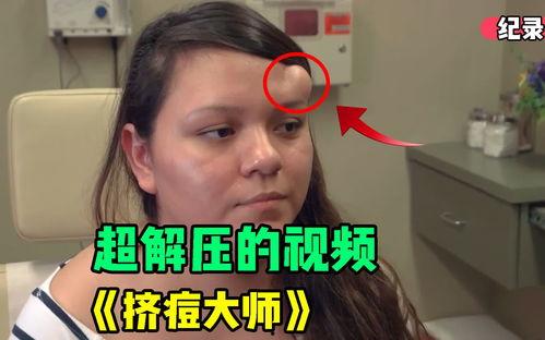 网红挤痘痘医生访谈节目,医生访谈揭示护肤误区与正确方法